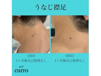 アクト クロ(ACT curro)/【うなじ襟足】脱毛施術例