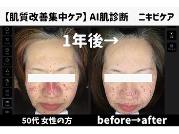 サロンスペース/50代女性 AI肌診断 1年後