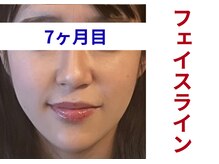 アミュレット 京都(amulette)/【フェイスライン】7ヶ月目