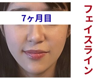 アミュレット 京都(amulette)/【フェイスライン】7ヶ月目