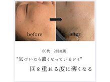 シミリセット 名駅(シミReset)/気づいたら濃くなるシミ・改善
