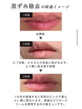 エピ(ep)&nbsp;メラニン 除去