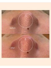 レア(Lea)/埋まった毛穴もスッキリ綺麗に