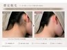 【満足度No.1】 美容師がデザイン☆うなじ脱毛☆ ¥6,000→¥3,000