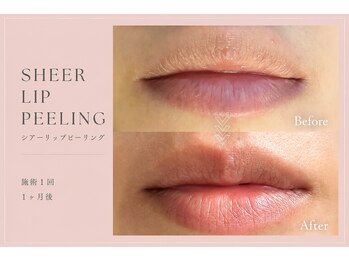 ワールドビューティー(World Beauty)の写真/【国家資格者施術】《半額モニター募集中》ローマピンクで話題！唇の黒ずみを桃色にする専門メラニンケア。