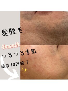 オリエンス(oriens)/【ヒゲ脱毛】