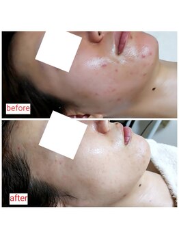 ミュー(Mieux)/大きなニキビはできなくなった