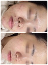 ニキビケア研究所 吉祥寺店/食事改善も施術と一緒に☆