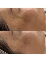 ヴェルシック(Belchic)/くすみがなくなるだけ印象も変化