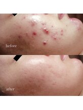 アーネスト 大阪心斎橋店(EARNEST)/究極肌管理【 毛穴・ニキビ 】