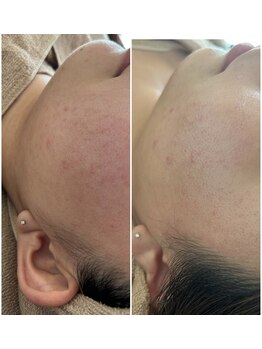 リノ(Lino)/毛穴、赤みにもワックス