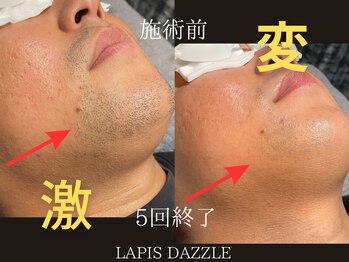 ラピスダズル(LAPIS DAZZLE)/髭脱毛☆途中経過(5回終了)