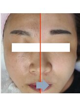 レベンディス(LEVENDIS)/ララピール×美容液導入