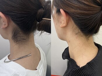 ミース 福岡本店/うなじ矯正◆ビフォーアフター