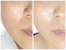 ラウン 京都(ROUN')/エンビロン・1回施術