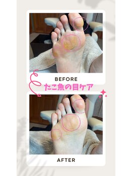 ドクターネイル爪革命 恵庭店/タコ魚の目ケア