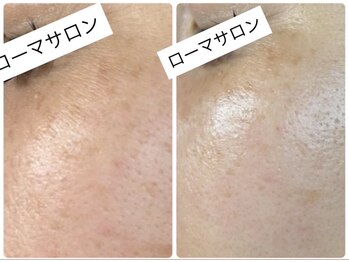 ローマサロン/白玉スノーピールトリートメント