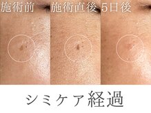 レイミー(reimee)/【シミケア経過】シミケア1回目