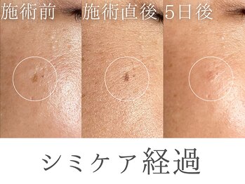 レイミー(reimee)/【シミケア経過】シミケア1回目