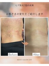 オフ(off)/ヒゲ脱毛