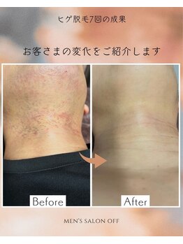 オフ(off)/ヒゲ脱毛