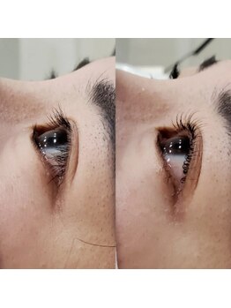 アイラッシュサロン モッペル(Eyelash Salon Moppel)/下がりまつげもくるん♪と改善