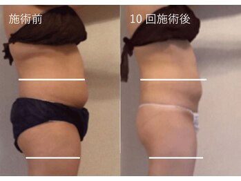 AK エステティックス(AK Esthetics)/痩身/姿勢改善★ウィンバック