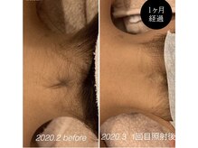 ララリア(LaLaLia)/襟足脱毛