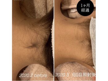 ララリア(LaLaLia)/襟足脱毛