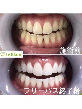 ルブラン 奈良店(Le Blanc)/３週間で驚きの変化！