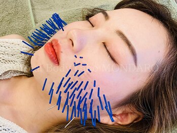 モンダロ(MONDARO)の写真/【はじめての美容鍼に◎】本格的な美容鍼だから継続して続けやすい♪美容鍼で小顔と美肌が同時に叶う◎