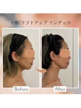 アピ(api)/症例写真【小顔インディバ】