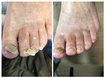 フレッシュフット(FreshFoot)/足のトラブルお任せください