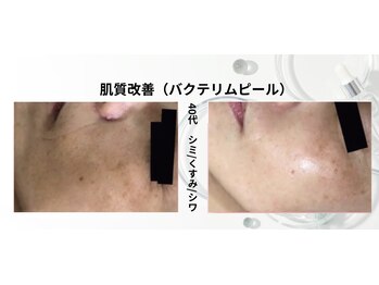 トレゾール(tresor)/★毛穴★40代（シミ/くすみ/シワ