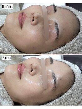 ソワナ(soina)/【神楽坂駅/フェイシャル/毛穴】