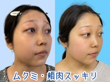 ナチュラルビューティーフェイス 横浜(NBF)/横顔・頬肉を小顔/横浜小顔矯正