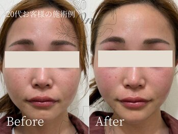 ワン(One)/美容鍼でスッキリ小顔へ