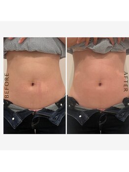 ルナート(Lunart)/大人気!!ラジオ波と腸もみ