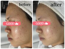 ニュウ(Nyu)/剥離なし☆ハーブピーリング