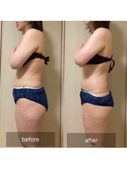 ココカラ(COCOKARA)/インディバ/アロマ　上半身痩せ