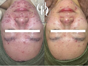 グロウ(GLOW)/【症例写真】集中プログラム