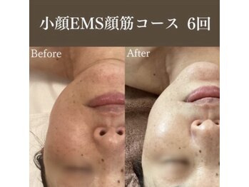 サロンドペシェ(salon de peche)/50代*EMS小顔リフト7回の変化