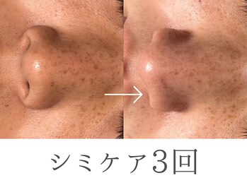 レイミー(reimee)/【シミケア3回】Before/After