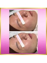 アイリープ(eyeleap)/☆筋膜リリース