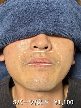 カナウ(KANAU)/【Sパーツ/脱毛】鼻下