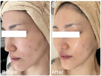 ナチュラ ソース(NatureSouce)の写真/毛穴レスな白玉肌へ！エイジングケアも叶う、極上フェイシャルでハリツヤUP☆