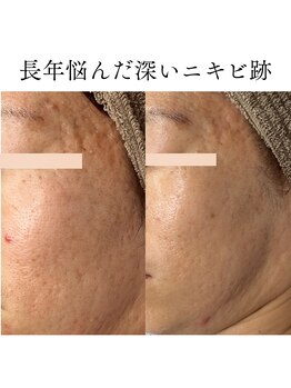 アロマ(AROMA)の写真/スペシャルケア【凹凸ニキビや開き毛穴に速攻アプローチ】剥離なし◎ダウンタイムなし◎施術後ツヤ肌実感◎