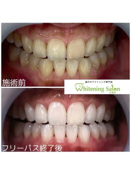 ホワイトニングサロン 札幌店/【ホワイトニング】#札幌#大通り