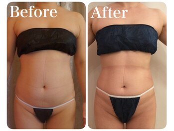 トータルビューティサロン クイーン(Queen)/●お腹まわり●