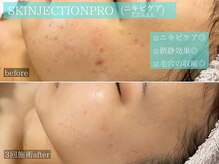 ラ ドゥーサ(La Dusa)/水光肌エステ/ニキビケア